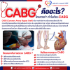 CABG คืออะไร? ใครควรทำ ทำไมต้อง CABG CABG คืออะไร? ใครควรทำ ทำไมต้อง CABG