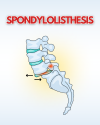 Spondylolisthesis Treatment with Spine Specialists