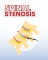 Numbness? Weakness? It Could Be Spinal Stenosis Numbness? Weakness? It Could Be Spinal Stenosis
