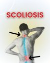 Best Hospital for Scoliosis Treatment in Thailand Best Hospital for Scoliosis Treatment in Thailand