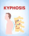 Expert Kyphosis Diagnosis and Treatment in Thailand Expert Kyphosis Diagnosis and Treatment in Thailand