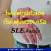 โรคนี้ชื่อ SLE หรือ ที่คนไทยมักเรียกว่า โรคพุ่มพวง