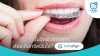 จัดฟันใส invisalign จัดฟันใส invisalign