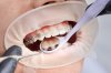 Damon Braces: A Faster, Less Painful Orthodontic Innovation for a Better Smile