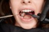 What Causes Tooth Decay? Symptoms, Prevention, and Early Warning Signs