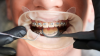 Metal Braces Metal Braces
