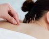 การฝังเข็ม Acupuncture