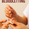การระบายเลือด 1จุด ( Bloodletting )