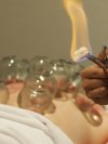 Cupping