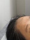 Beauty Acupuncture
