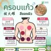 ครอบแก้ว (Cupping) ครอบแก้ว (Cupping)