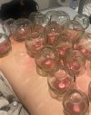 ครอบแก้ว Cupping