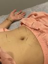 ฝังเข็มกระชับสัดส่วน (Slimimimg Acupuncture)