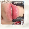 Global MasterJuberryJJ lip blush after healed Global MasterJuberryJJ lip blush after healed