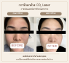ภาพก่อนและหลัง CO2 Laser บริเวณใบหน้า ผลลัพธ์แตกต่างกันในแต่ละบุคคล