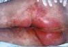 แนวทางปฎิบัติเพื่อป้องกันแผลกดทับ (Incontinence Skin Care)
