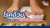 โรคอ้วน ถือเป็นโรค NCDs ที่พบได้มากที่สุดในปัจจุบัน!!! โรคอ้วน ถือเป็นโรค NCDs ที่พบได้มากที่สุดในปัจจุบัน!!!
