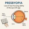 สายตายาวตามอายุ (Presbyopia) คืออะไร? สายตายาวตามอายุ (Presbyopia) คืออะไร?
