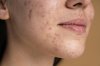 เซ็บเดิร์ม (Seborrheic Dermatitis): ผื่นผิวหนังอักเสบที่ไม่ควรมองข้าม พร้อมวิธีรักษาและป้องกัน เซ็บเดิร์ม (Seborrheic Dermatitis): ผื่นผิวหนังอักเสบที่ไม่ควรมองข้าม พร้อมวิธีรักษาและป้องกัน