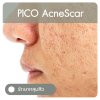 PICO ACNE