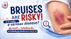 BRUISES ARE RISKY! Is it really a serious disease? BRUISES ARE RISKY! Is it really a serious disease?