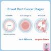 มะเร็งระยะศูนย์ (DCIS) คืออะไร? ยังไม่แพร่กระจายแต่ทำไมต้องรักษา มะเร็งระยะศูนย์ (DCIS) คืออะไร? ยังไม่แพร่กระจายแต่ทำไมต้องรักษา