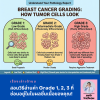 มะเร็งเต้านม Grade 1, 2, 3 คืออะไร? เข้าใจวิธีวัดความดุร้ายของเซลล์มะเร็ง มะเร็งเต้านม Grade 1, 2, 3 คืออะไร? เข้าใจวิธีวัดความดุร้ายของเซลล์มะเร็ง