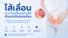 ใส้เลื่อน, ปวดท้อง เซเปี้ยนซ์, sapiens,  อายุรกรรม