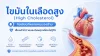 ไขมันในเลือดสูง, เซเปี้ยนซ์, sapiens ไขมันในเลือดสูง, เซเปี้ยนซ์, sapiens
