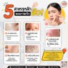 5 สาเหตุหลักของการเกิดสิว!! 5 สาเหตุหลักของการเกิดสิว!!