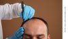 smp_scalp_micropigmentation_ผมบางทำยังไงดี