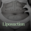 Liposuction