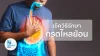 วิธีรักษากรดไหลย้อน