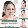 ตัดถุงใต้ตา แผลใน