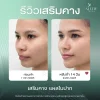 รีวิวเสริมคาง รีวิวเสริมคาง