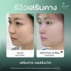 รีวิวเสริมคาง โคราช