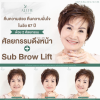 review facelift รีวิวดึงหน้า sub brow lift