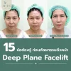 ดึงหน้า deep plane facelift ดึงหน้า deep plane facelift