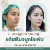 เสริมจมูกโอเพ่น เสริมจมูกโอเพ่น