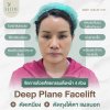 ดึงหน้าชั้นลึก deep plane facelift