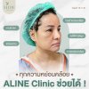 ดึงหน้าชั้นลึก deep plane facelift