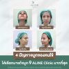 แก้จมูกโคราช