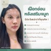 ตัวอย่างการแปะเฝือกอ่อนหลังเสริมจมูกที่ ALINE Clinic โคราช ช่วยพยุงทรง ลดบวม และป้องกันการกระแทก เพื่อผลลัพธ์ที่สวยเป๊ะในระยะยาว