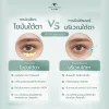 จัดเรียงไขมันใต้ตา VS ฉีดฟิลเลอร์ใต้ตา