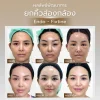 ยกคิ้วส่องกล้องพักฟื้นนานไหม