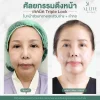 รีวิวดึงหน้า รีวิวดึงหน้า