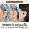แผลดึงหน้า แผลดึงหน้า
