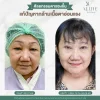 ก่อนหลังผ่าตัดกล้ามเนื้อตาอ่อนแรง ALINE Clinic ก่อนหลังผ่าตัดกล้ามเนื้อตาอ่อนแรง ALINE Clinic