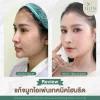 แก้จมูกโอเพ่น