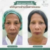 ก่อนหลังผ่าตัดกล้ามเนื้อตาอ่อนแรง ALINE Clinic ก่อนหลังผ่าตัดกล้ามเนื้อตาอ่อนแรง ALINE Clinic